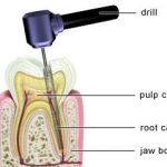 PD_Root_Canal